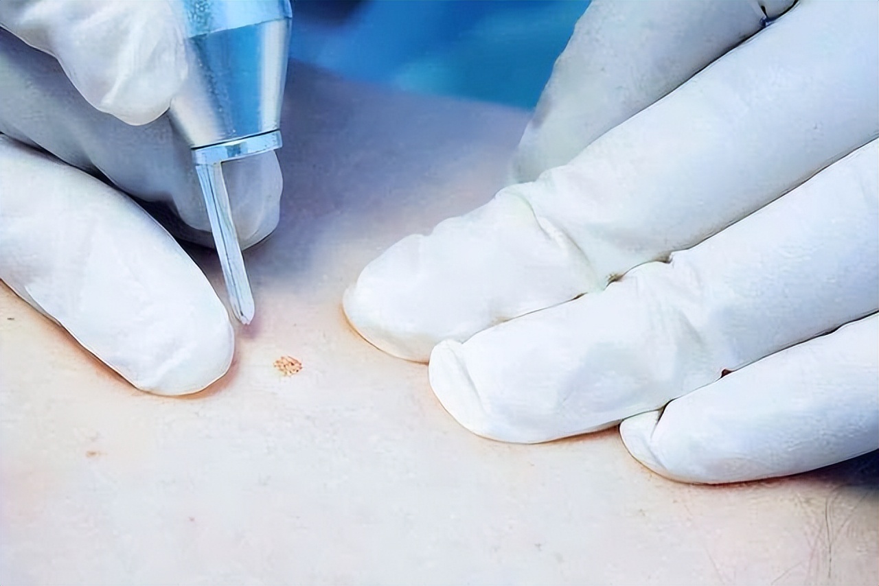 皮肤长“小肉球”是怎么回事，可以抠掉吗？该如何去除？望知晓