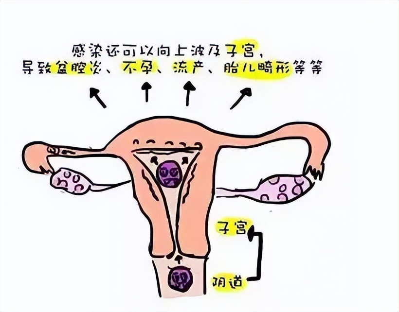 阴道炎常反复，怎么办？医生：远离阴道炎，你需要知道这3件事