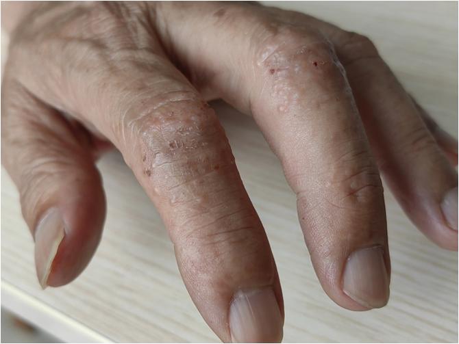 对镍过敏是怎么回事,镍过敏的人多不多