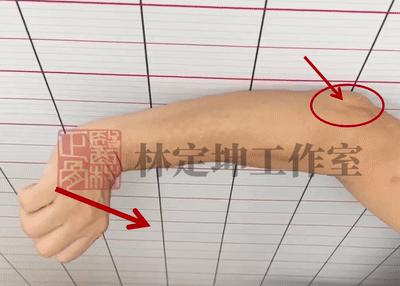手肘筋劳损最快恢复方法,肘关节错位中医正骨