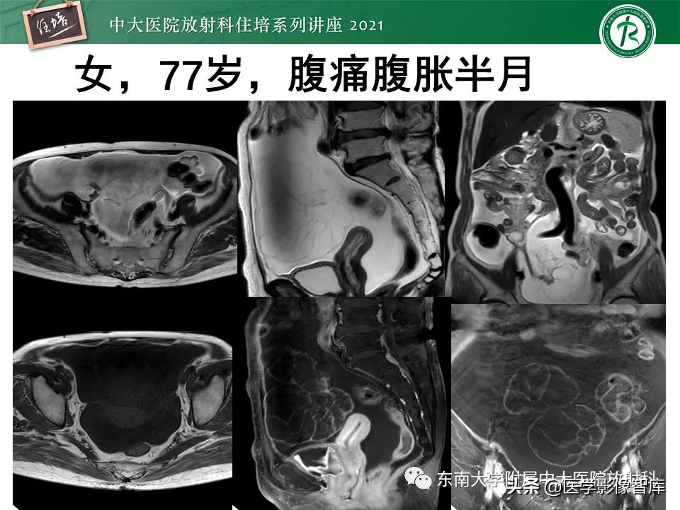 卵巢浆液性肿瘤的肉眼及镜下特征,卵巢原发性粘液性囊腺瘤