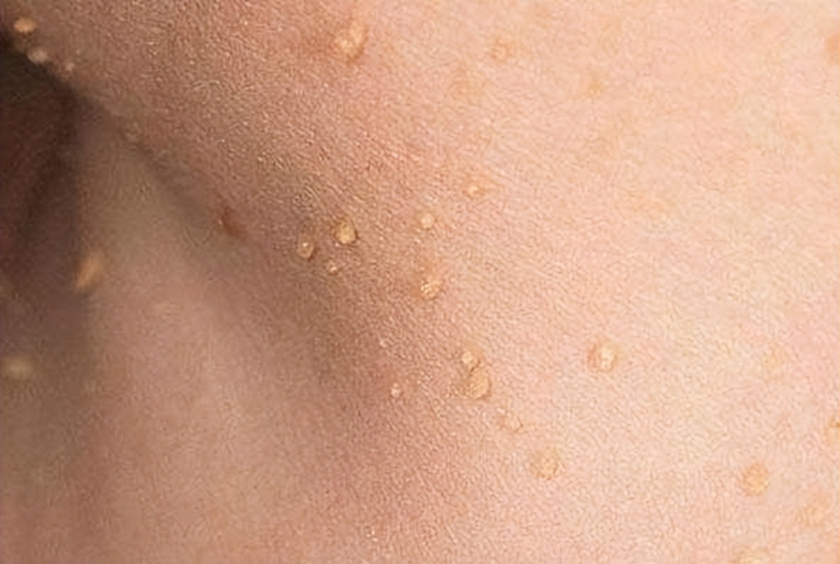 脖子腋下长小肉粒什么原因引起的,脖子上和腋下长小肉粒是什么原因