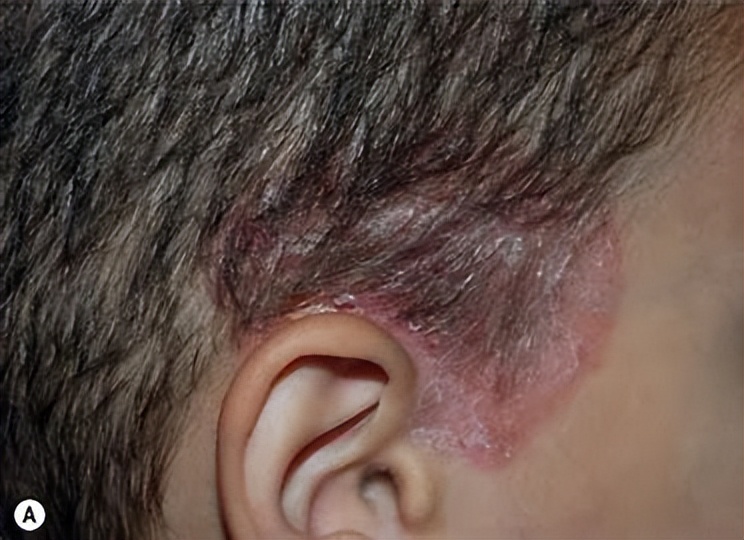 脂溢性皮炎头皮还能长头发么,头皮脂溢性皮炎与白头发有关