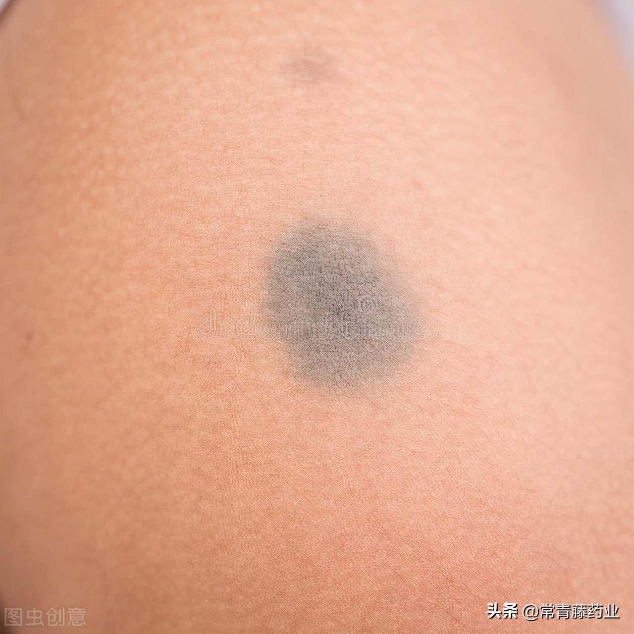 如何分辨晒斑色斑,晒斑与黄褐斑雀斑的区别