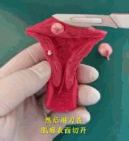 不同的子宫肌瘤都长啥样？看医生如何切除
