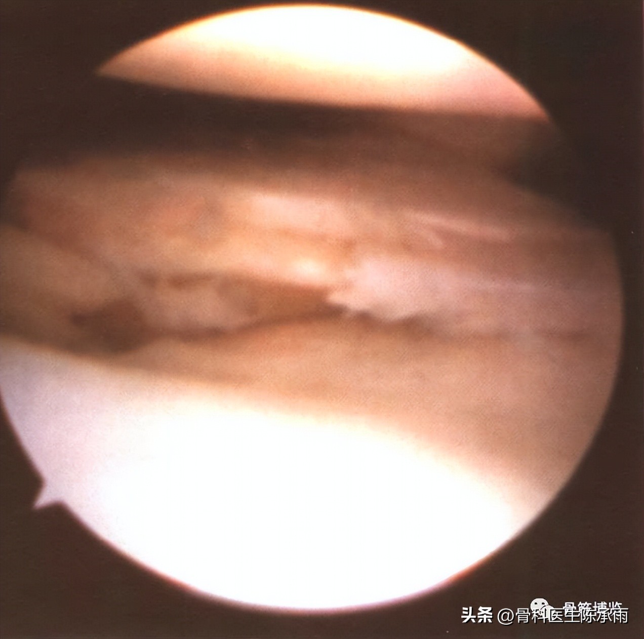 盘状半月板撕裂一级,半月板层裂愈合概率