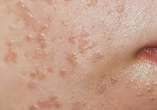 眼周起红色的小疙瘩是怎么回事,眼周起的小疙瘩别忽视