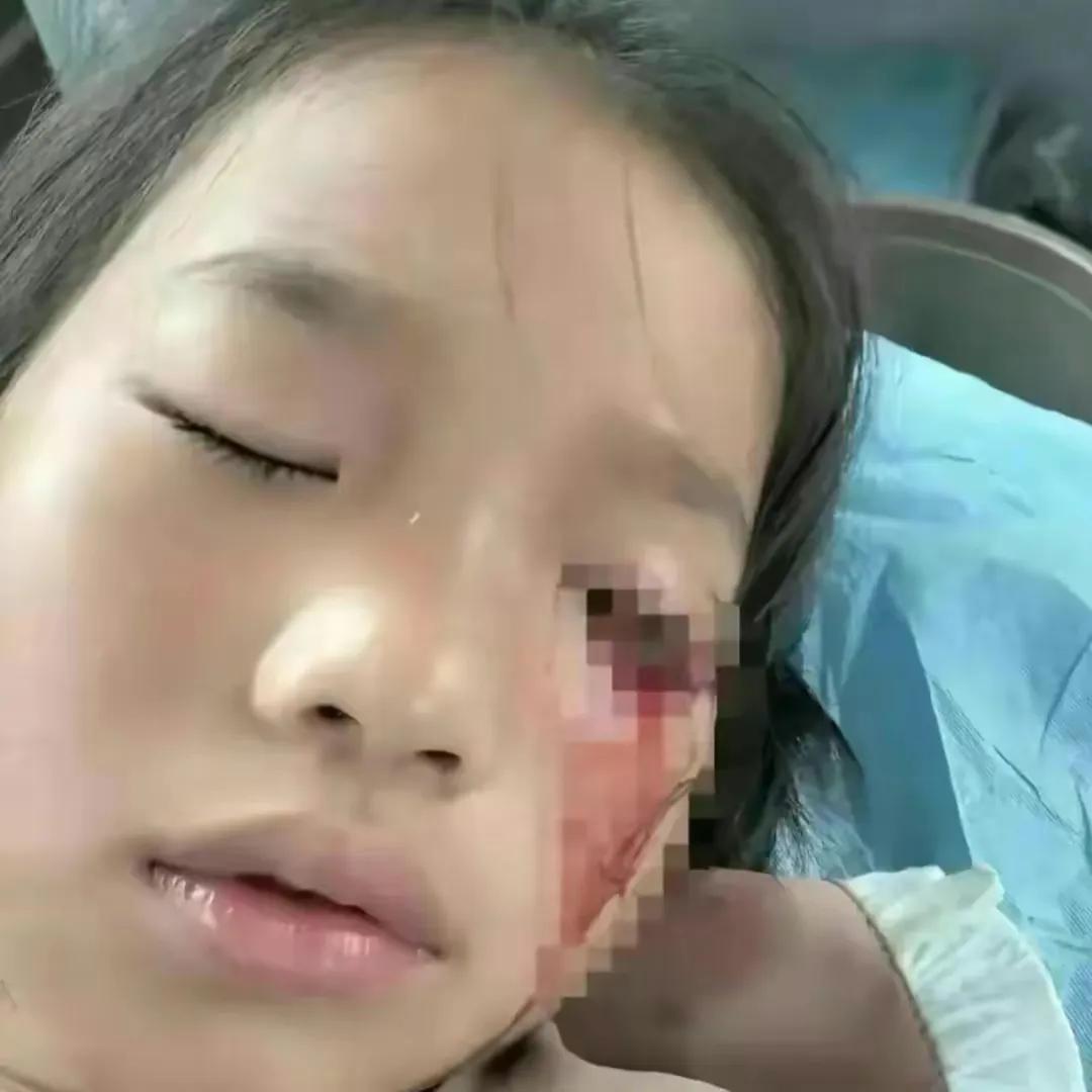 弹弓误伤人眼睛,弹弓伤人事件真实案例