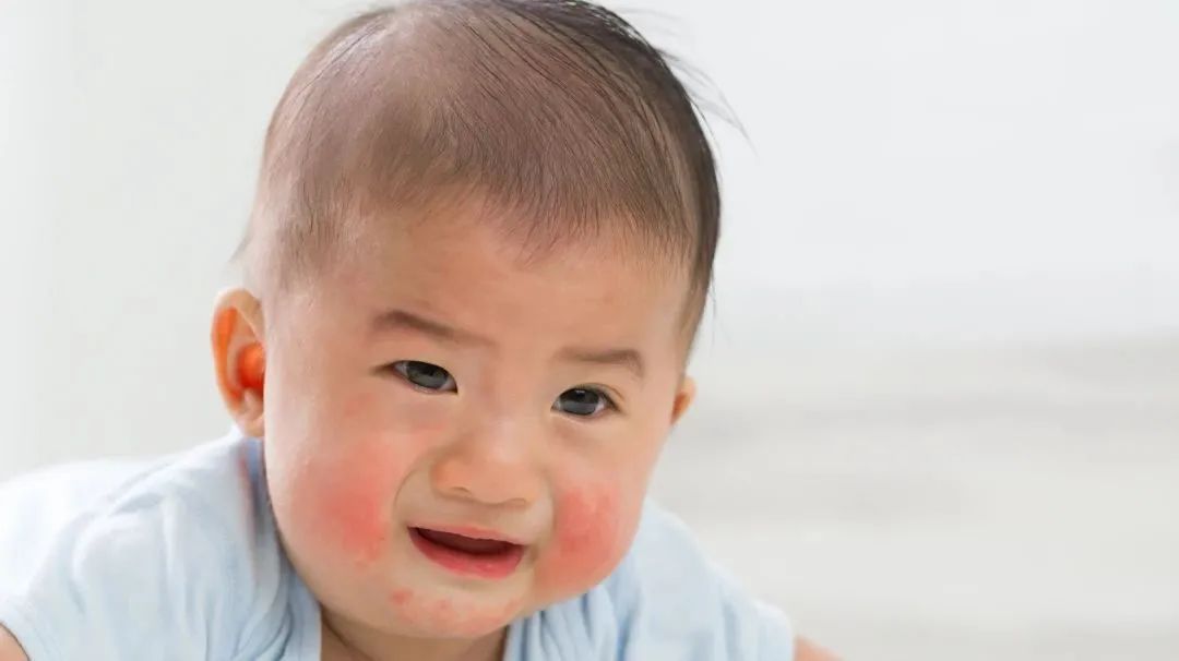 湿疹反复发作怎样做才能好得快,他克莫司软膏治疗湿疹反复发作