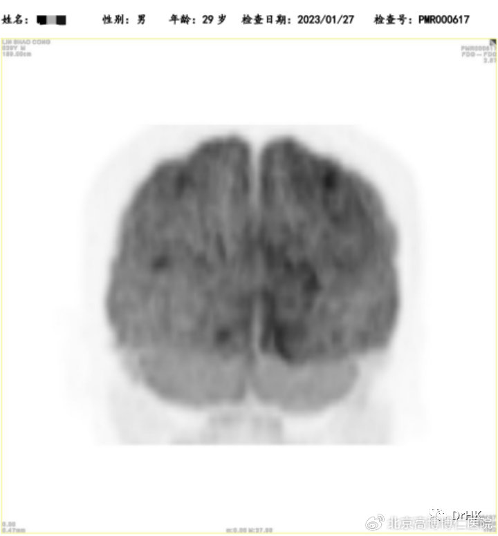 cart治疗淋巴瘤失败会怎样,car-t治疗晚期淋巴瘤的成功率