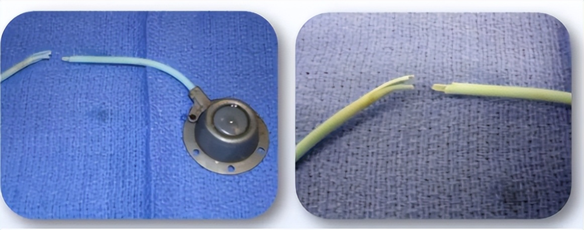 癌症病人输液港是什么,输液港对癌症有什么危害