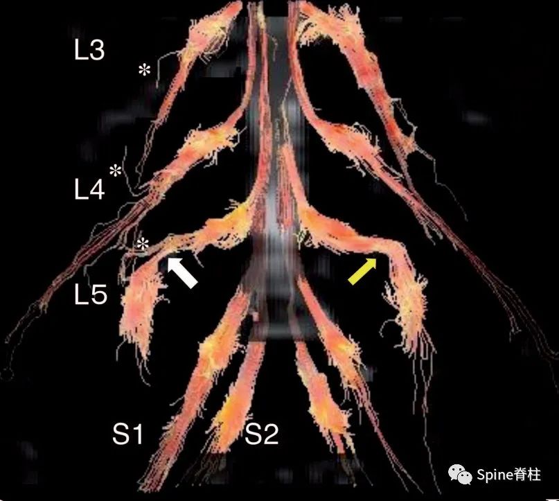 腰椎间盘突出症的治疗方法,腰椎间盘突出症状主要有哪些