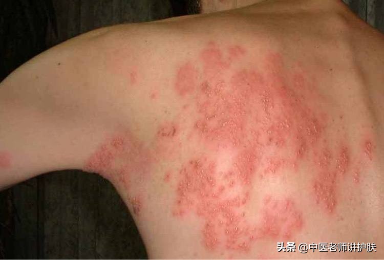 带状疱疹疼痛难忍有什么特殊药物,疼痛带状疱疹