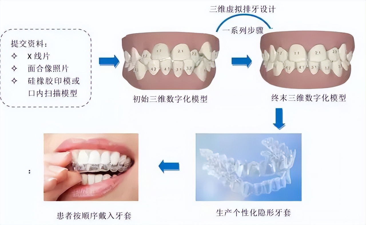 美恒隐形矫正怎么样,隐形矫正牙齿的过程