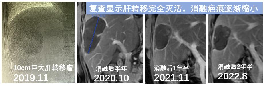 介入栓塞+微波消融：消灭肠癌病人10公分肝转移瘤，无瘤健康过3年