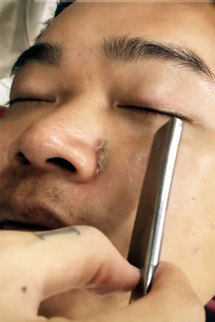 脸上起皮了是怎么回事,脸上起皮是什么原因怎么办