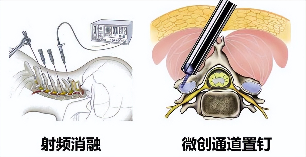 颈椎什么情况可以做微创手术,颈椎什么情况可做微创手术