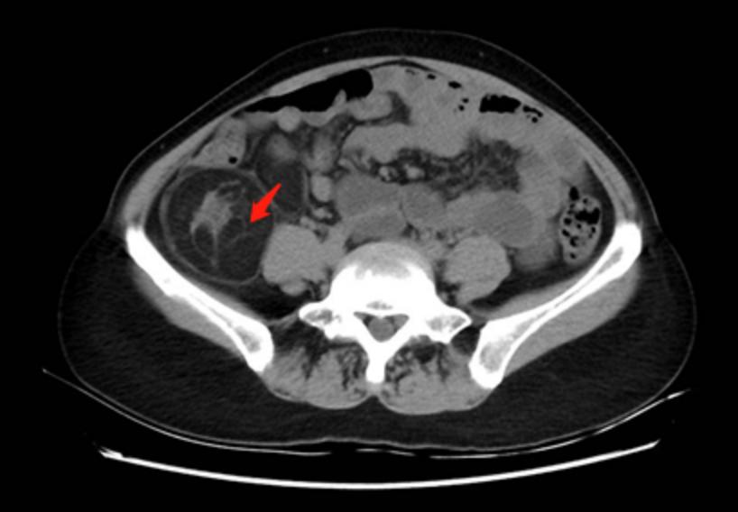 林丽珠治疗癌症方子,林丽珠治疗晚期肿瘤医案