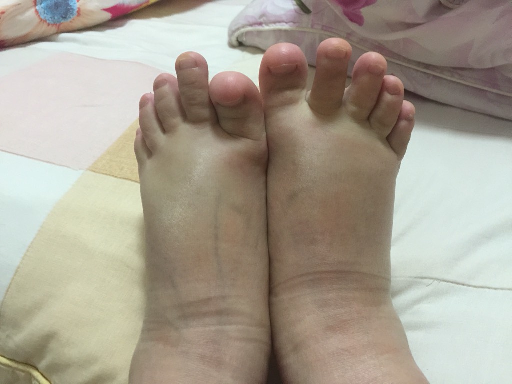 水肿的原因是身体缺水吗,水肿是身体出现什么问题了吗