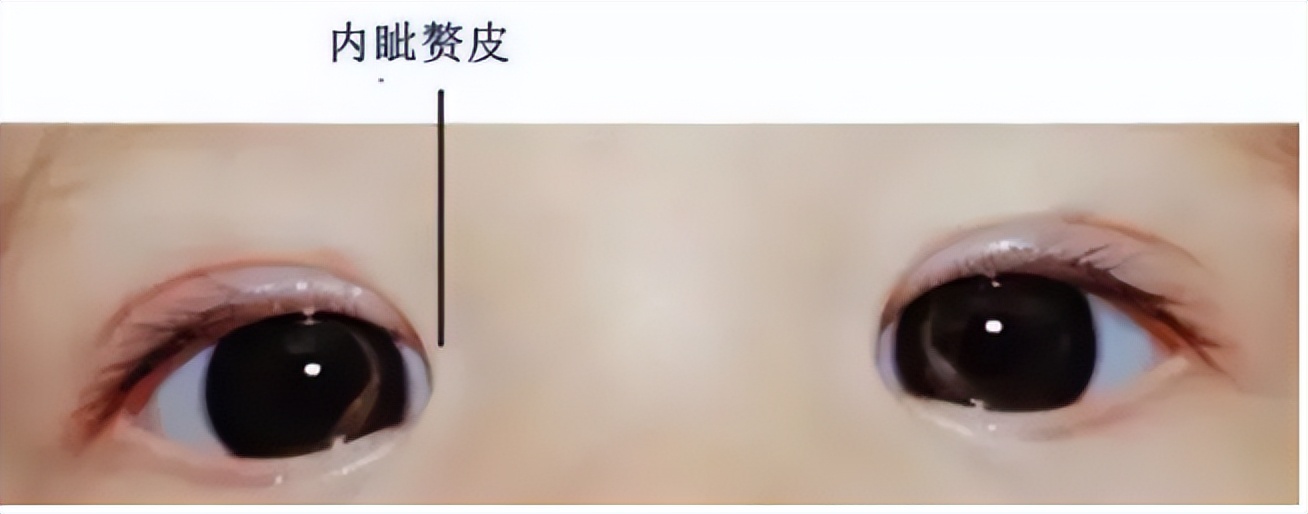 河南两兄弟割双眼皮被劝退,郑州割双眼皮失败男子