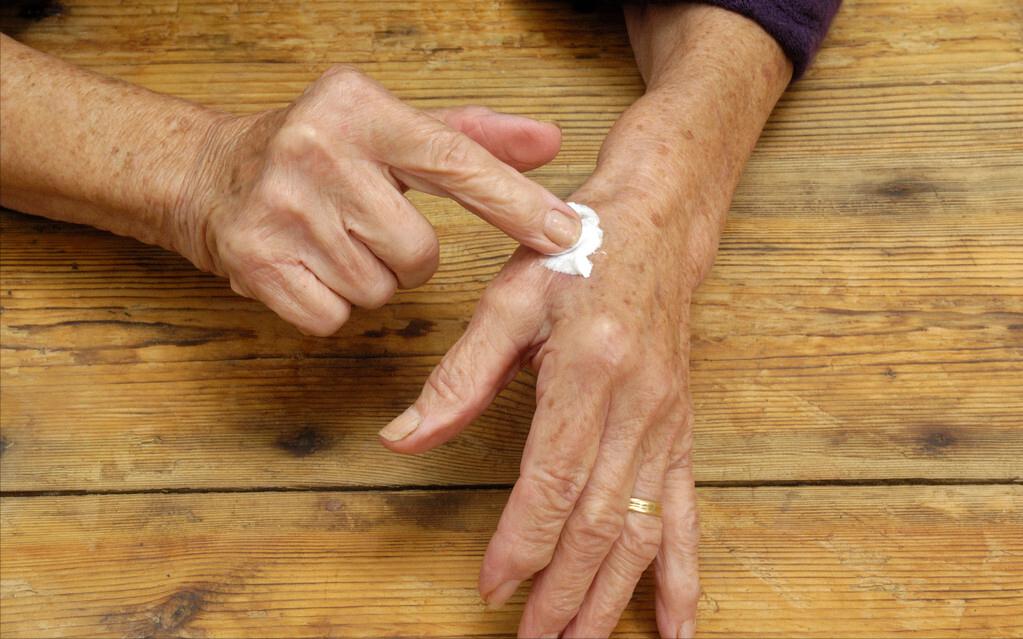 怎么用红霉素软膏祛除老年斑,祛老年斑的最佳方法红霉素软膏