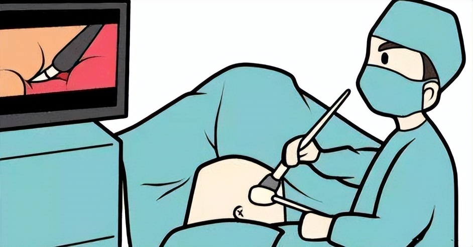 这种方式的腹腔镜手术，真正实现腹部“零瘢痕”