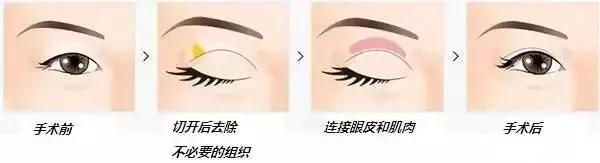 双眼皮修复小知识,双眼皮修复干货分享