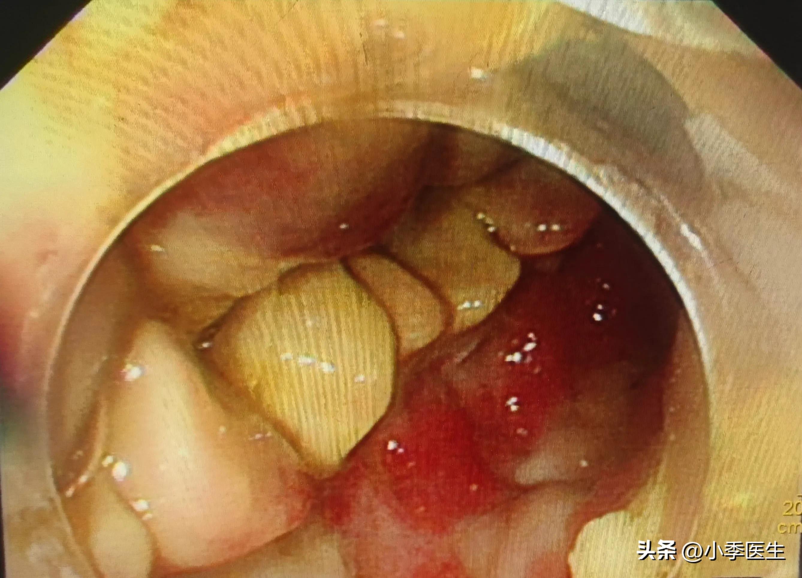 腹痛便血颜色是鲜红色,腹痛便血柏油便