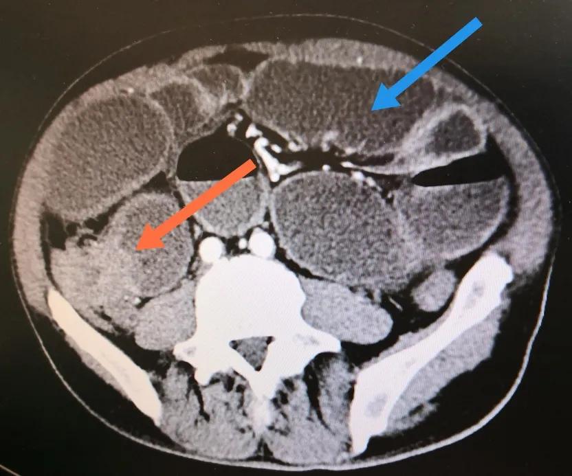 腹腔镜下结肠癌根治术,腹腔镜下结肠癌根治术手术步骤