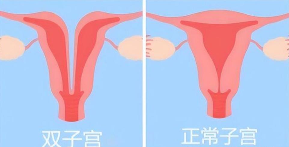 女子检查出两个子宫,女子查出双子宫