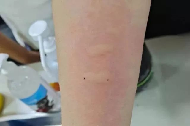 鼻塞流涕咳嗽有痰是属于什么感冒,单侧鼻塞要警惕三种病