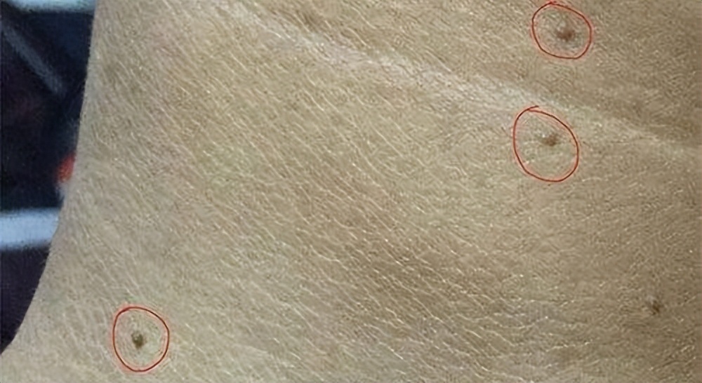 脖子腋下长小肉粒什么原因引起的,脖子上和腋下长小肉粒是什么原因