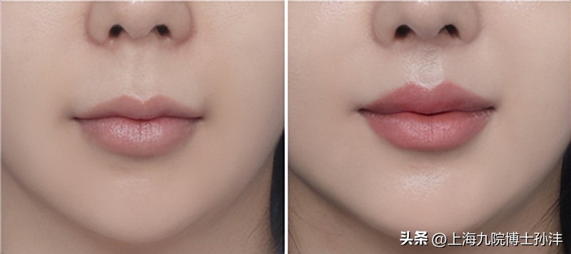 人中太长怎么缩短不留疤,人中长缩短术