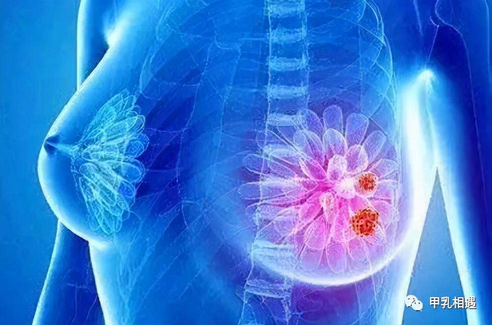 乳腺增生结节怎么消除小妙招,乳腺结节超声诊断分级