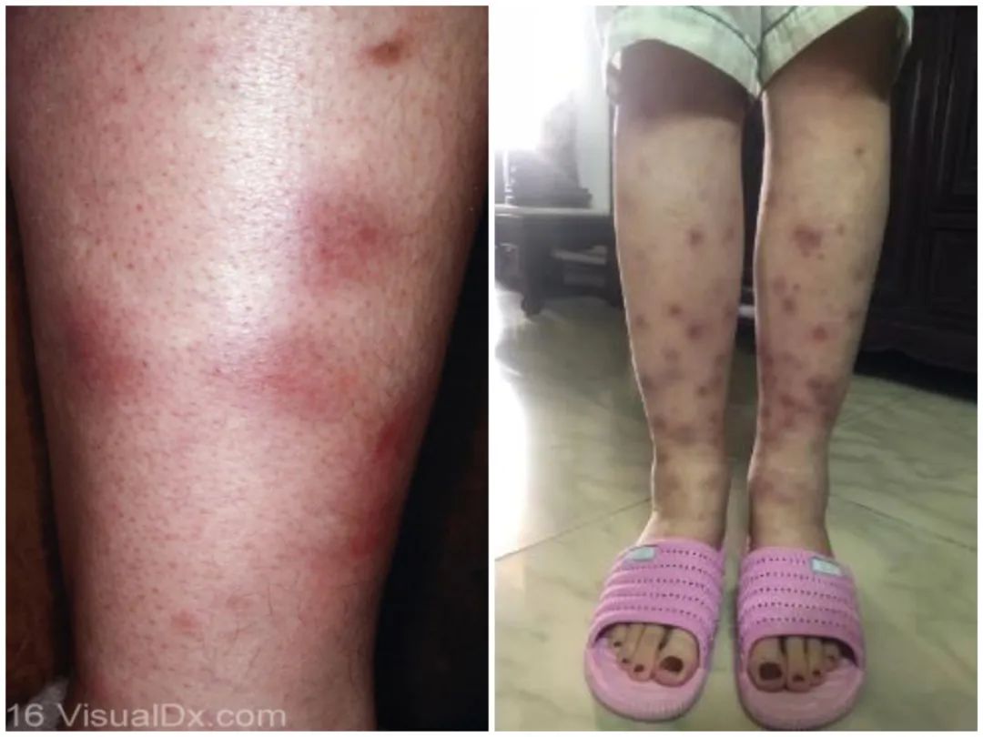 月子里的风湿病能自愈吗,产后风湿病可以自愈吗知乎