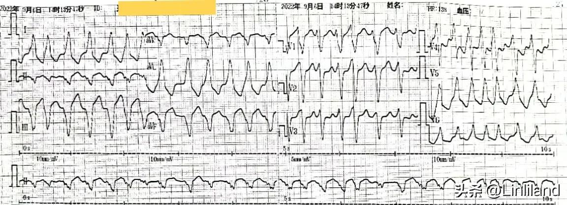 过速性房颤治疗,持续性房颤心动过速