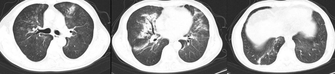 如何解读mNGS阴性结果？何时可能出现假阴性？真阴性又是为何？
