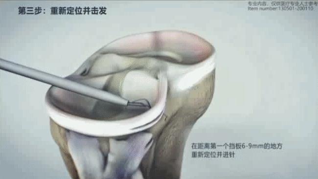 半月板缝合有后遗症吗,半月板缝合后康复训练