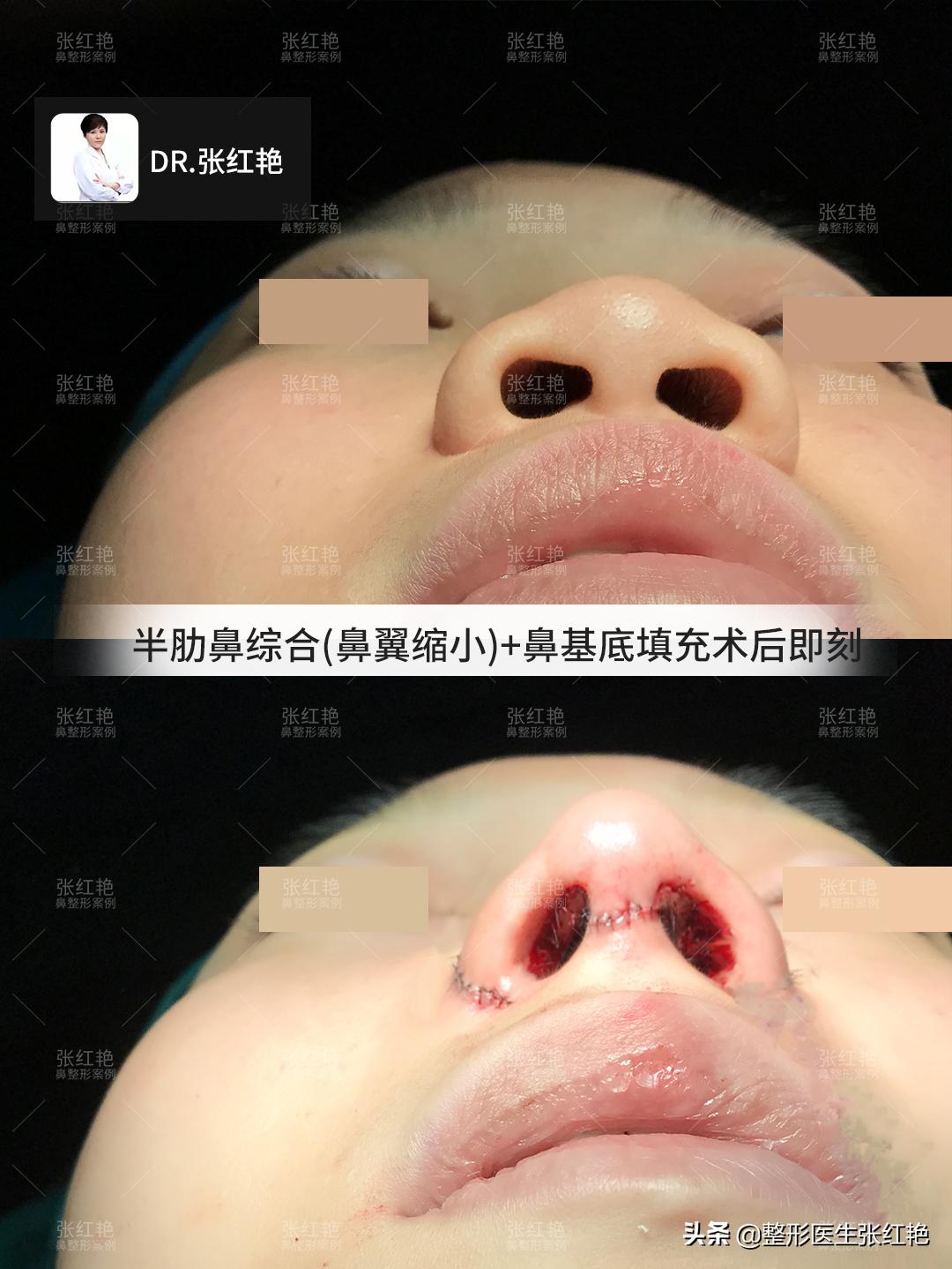 缩鼻翼怎么不留疤,缩鼻翼疤痕凸起