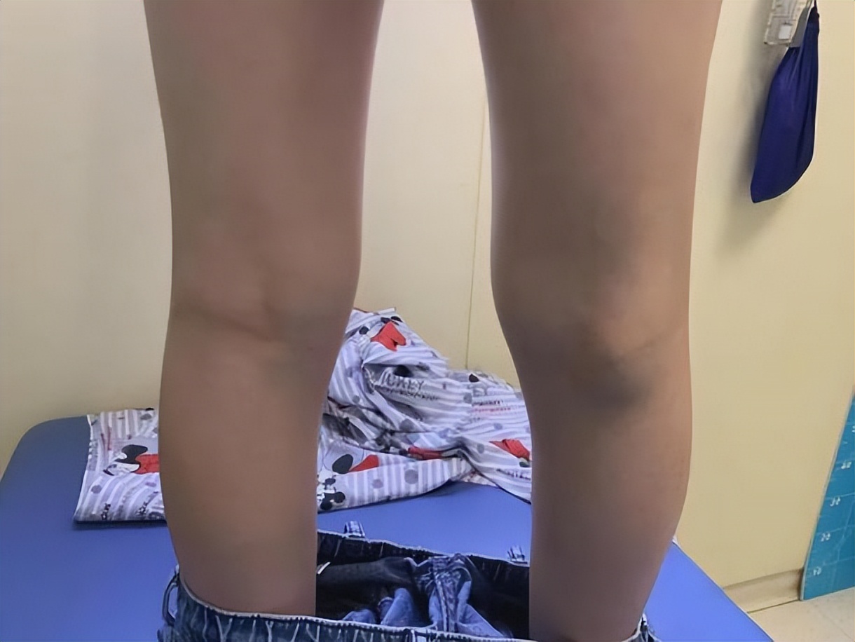 腿窝旁边起了一个鼓包是积液吗,腿左侧腘窝囊肿怎么治疗