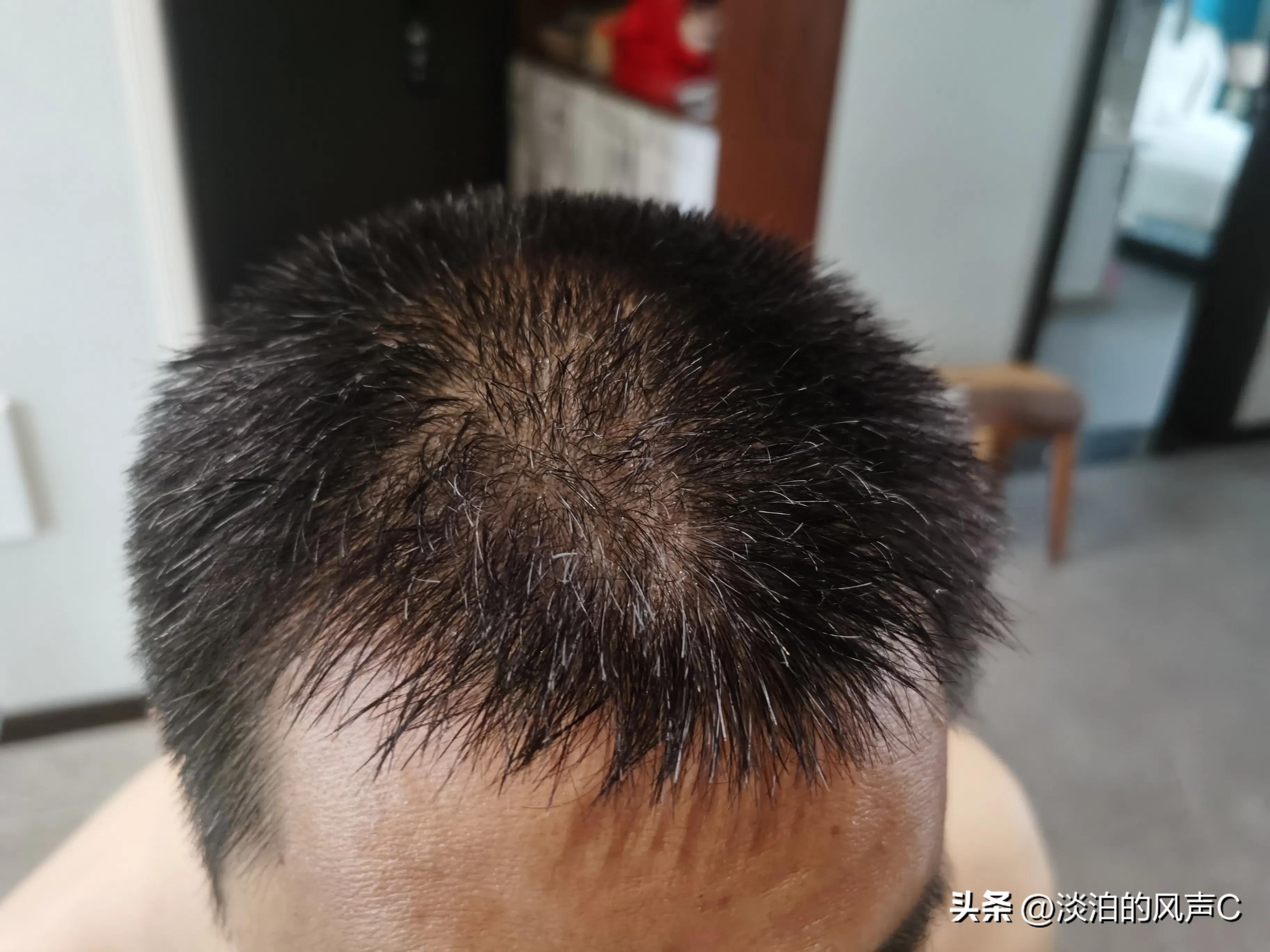 白发掉发头皮屑多吃什么改善,解决白发掉发头皮屑一切问题