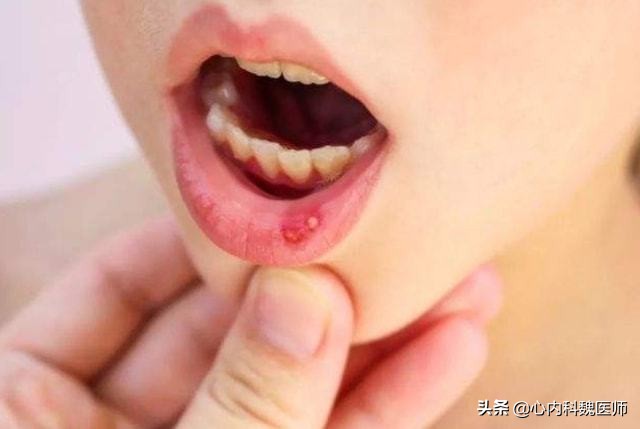 高血压吃维生素b2的作用与功效,糖尿病高血压可以吃维生素b2吗