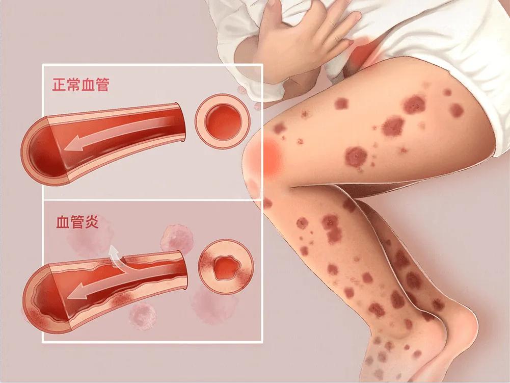 滁州中西医结合医院过敏性紫癜,过敏性紫癜中西医结合记忆口诀