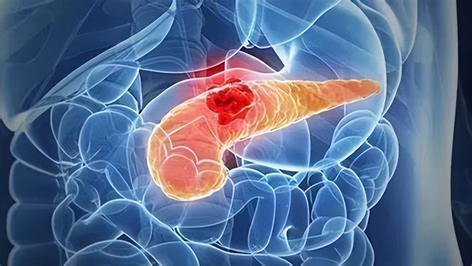 上腹部疼如何区分胃病和胰腺癌,胃痛不一定都是胃病要警惕胰腺癌