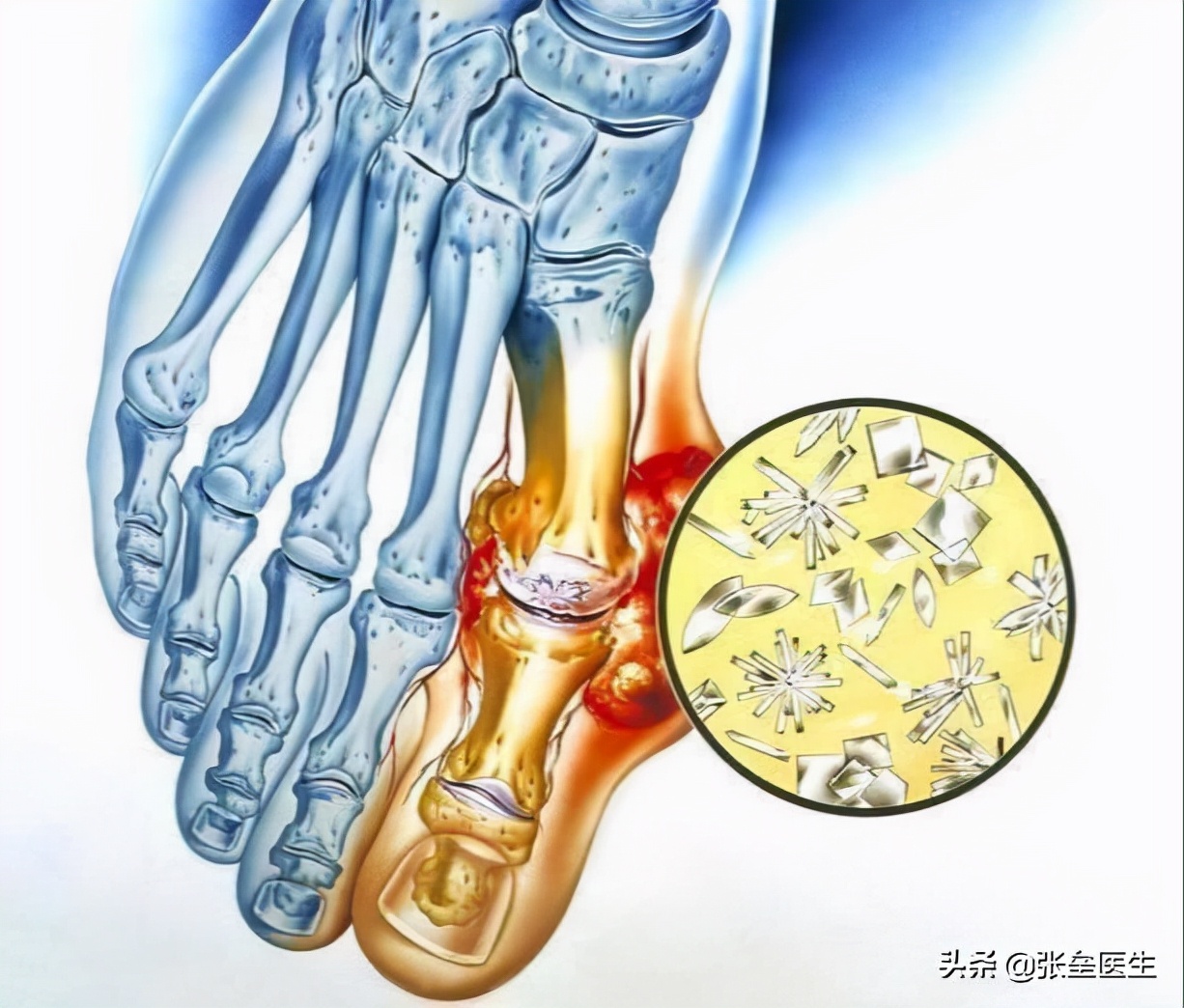 怎样才能确定是痛风性关节炎,关节疼如何区分是痛风还是风湿