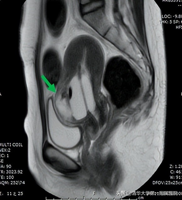瘢痕妊娠七个月剖宫产,危险的孕妇