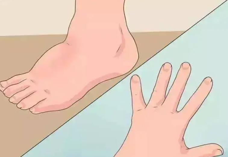 假性糖尿病与糖尿病区别,怎么知道是不是糖尿病前兆