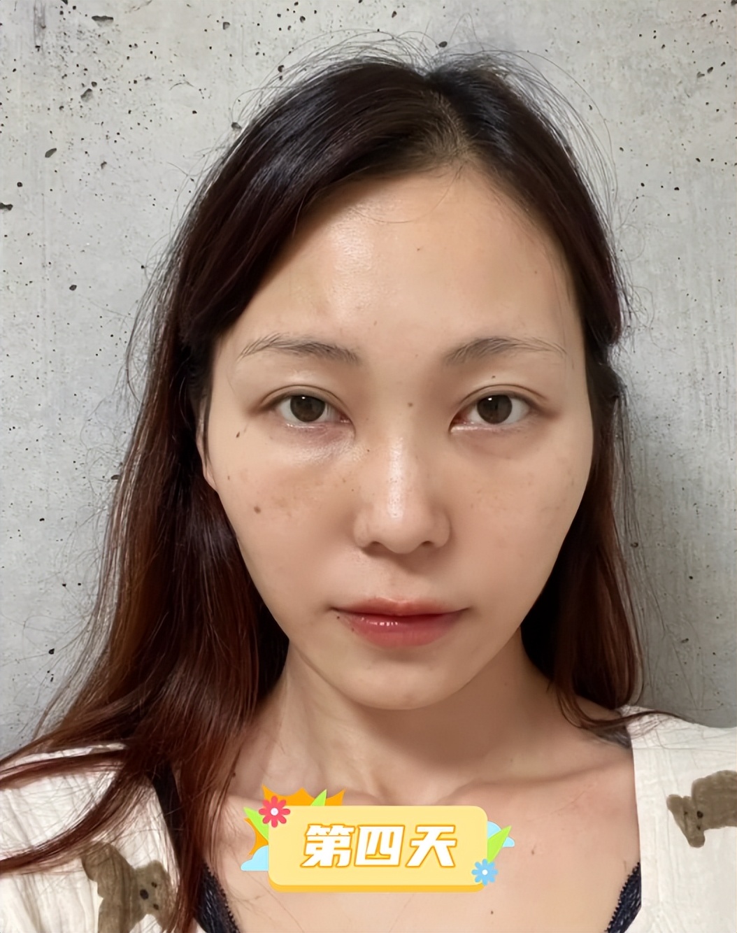 内切去眼袋手术全过程,做了去眼袋手术五天怎么还有眼袋