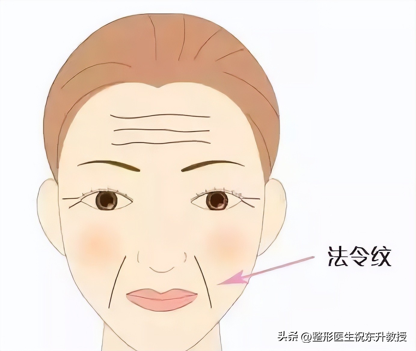 拉皮改善法令纹手术的危害有哪些,脸部法令纹做手术怎么去除