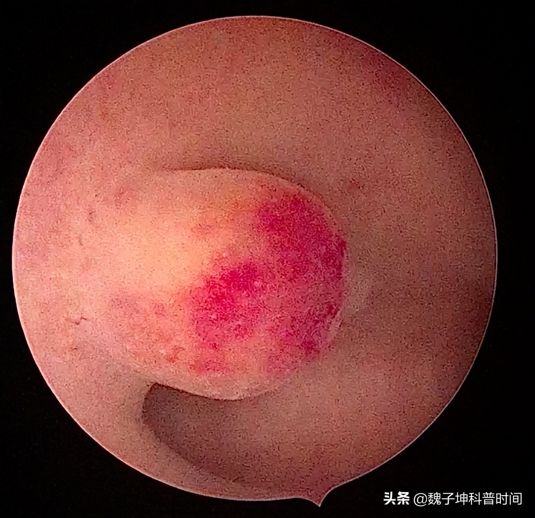 宫腔镜能查到什么,宫腔镜能查到宫颈病变吗